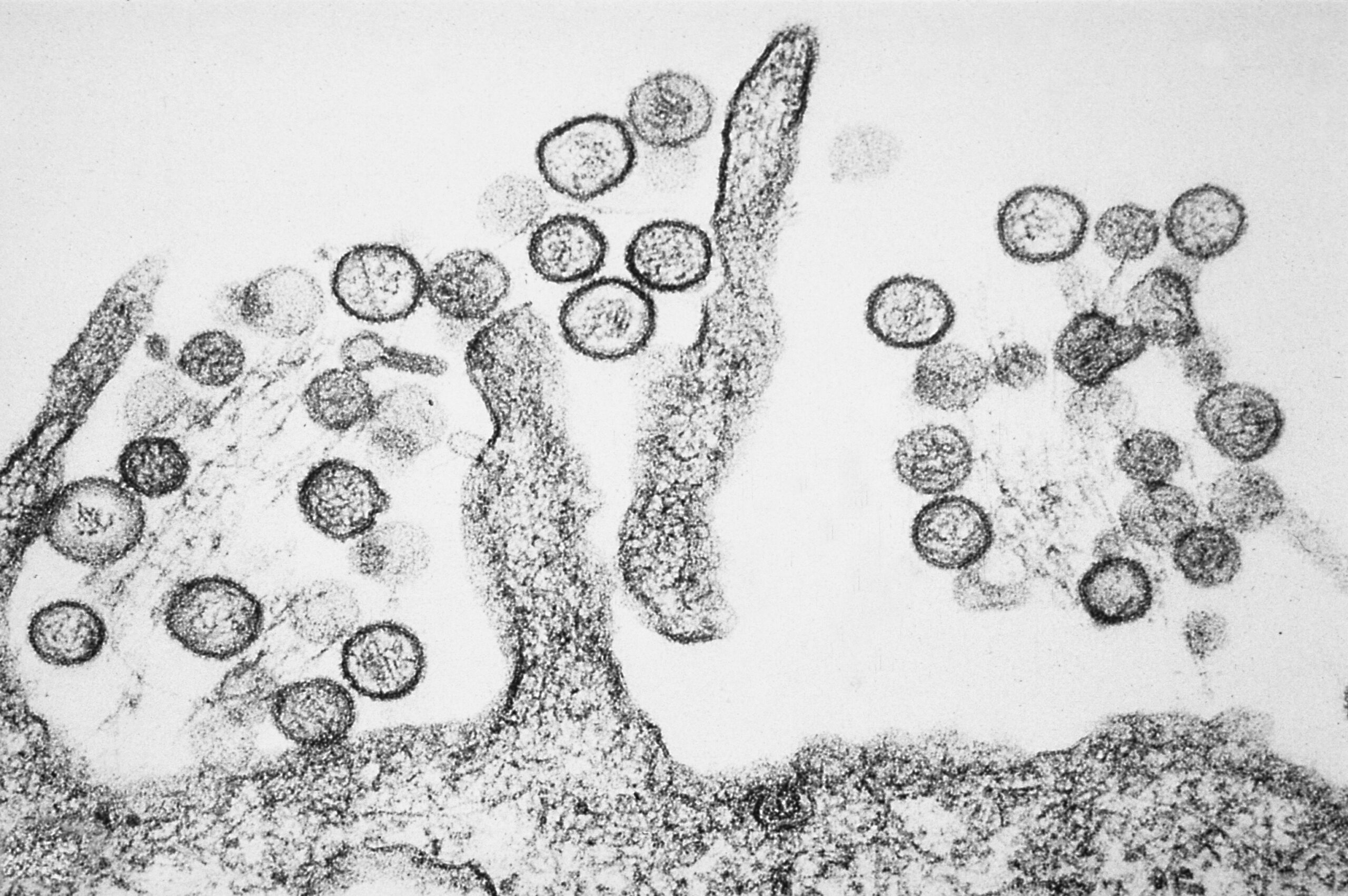 Hantavirus Pulmonary Syndrome Has a 38% Mortality Rate — And Most Patients Thought They Had the Flu Until Day Four